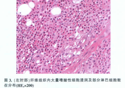 igg4相关硬化性腮腺炎1例