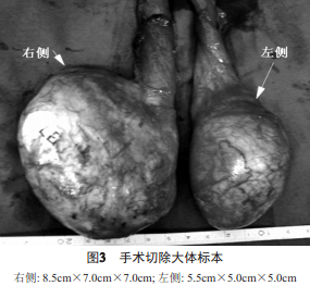 故诊断双侧睾丸肿瘤,行腹股沟切口双侧睾丸根治性切除术.