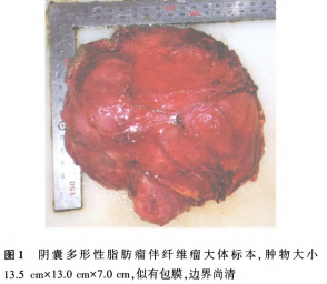 阴囊多形性脂肪瘤伴发纤维瘤一例