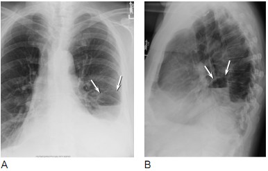 图8 肺脓肿a 胸部正位片;b.