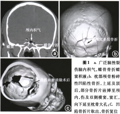 后颅窝多发骨折骑跨血肿鼻漏抢救成功一例