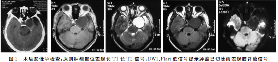 颅底硬膜外巨大胆脂瘤一例