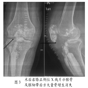 右下肢蜡泪样骨病1例及文献复习