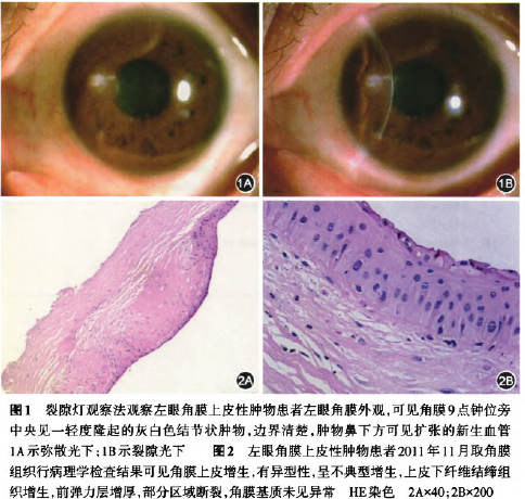 最后诊断:左眼角膜上皮不典型增生.