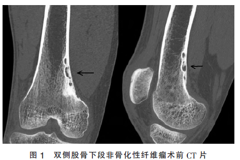 双侧股骨下段非骨化性纤维瘤1例