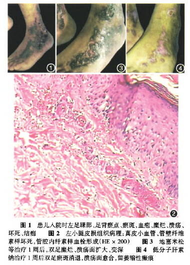 儿童青斑血管炎一例