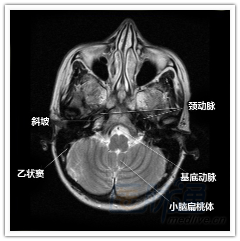 简明易懂的脑部断层解剖:横断位mri