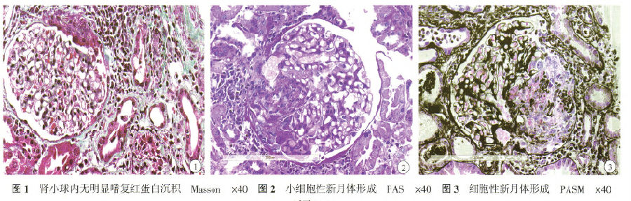 报告:活检唇腺Ⅲ型新月体性肾小球肾炎;肾损伤(aasa)血管炎肾脏穿刺