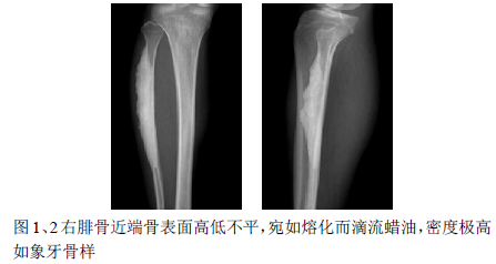 蜡样骨病一例