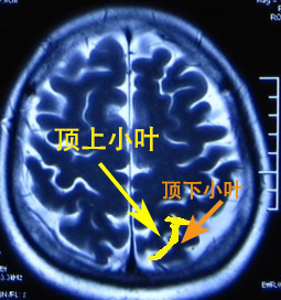 在内侧面,顶叶与枕叶的分界为