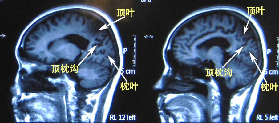在内侧面,顶叶与枕叶的分界为顶枕沟,横断面虽然也可以,但远不如矢状