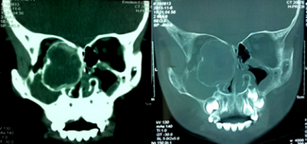 图2 外院鼻窦ct 左侧筛窦,蝶窦见软组织密度影,局部病变密度较高,病变