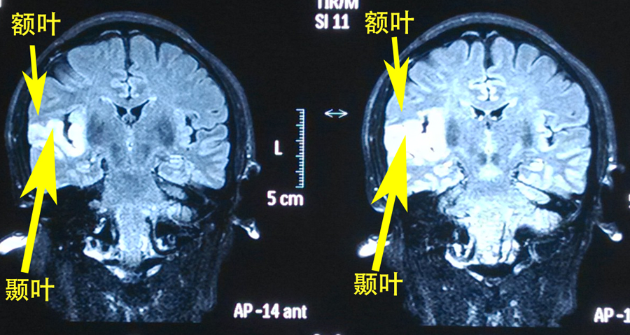 一步一步学神经解剖之清楚明白的颞叶_颞叶_神经解剖_神经影像学_外侧