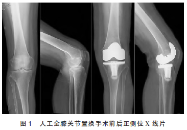 人工全膝关节置换术后深部血肿1例