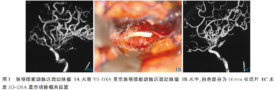 脉络膜前动脉远端破裂动脉瘤1例