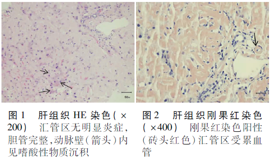 he染色嗜酸性物质沉积(图1,刚果红染色阳性(图2,诊断为肝淀粉样变性