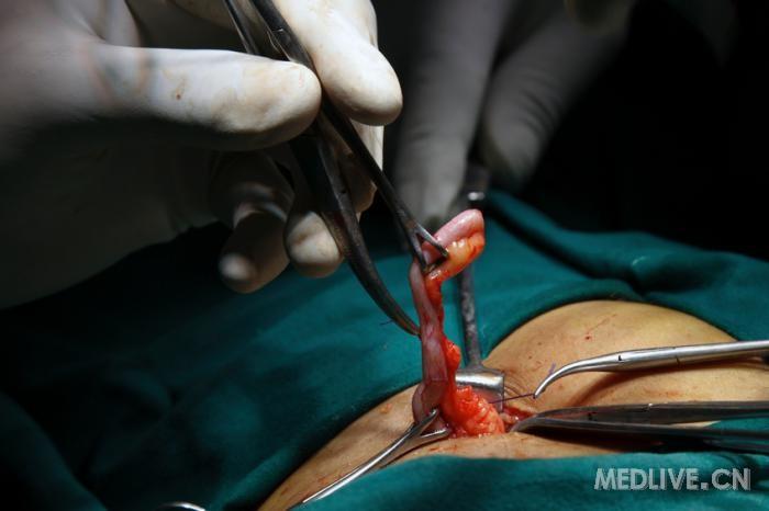 开腹手术◆外科医生通过右下腹单一切口切除阑尾◆开腹手术是阑尾