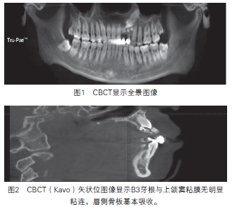 cbct指导手术摘除上颌牙瘤2例