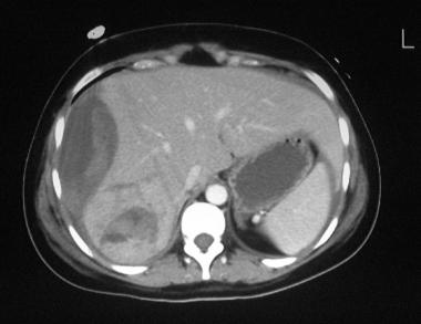 肝外伤影像学之:计算机断层扫描(ct)