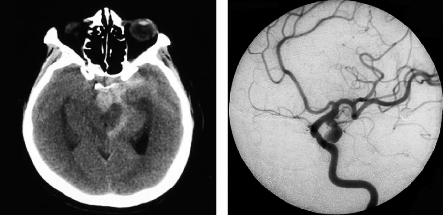 多图|颅内动脉瘤的影像学诊断