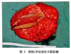 颈部巨大良性对称性脂肪瘤病4例