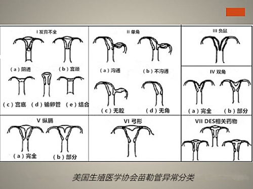 病例解读单角子宫残角妊娠一例