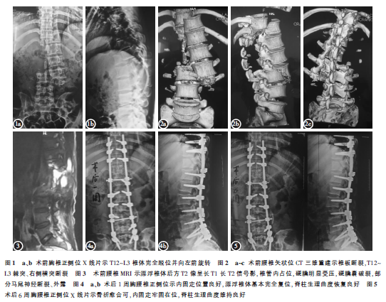 经典病例 > 正文 影像学检查:胸椎正侧位x线片示t12～l3椎体完全脱位