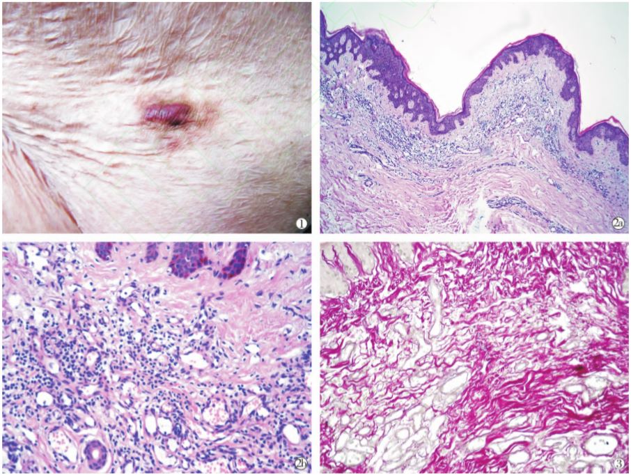 获得性弹性组织变性血管瘤1例国内首报