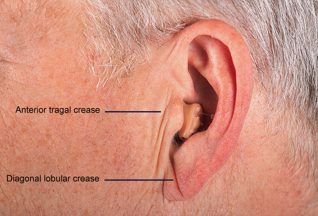 一研究发现71%存在耳朵褶皱的受试者患有心脏疾病