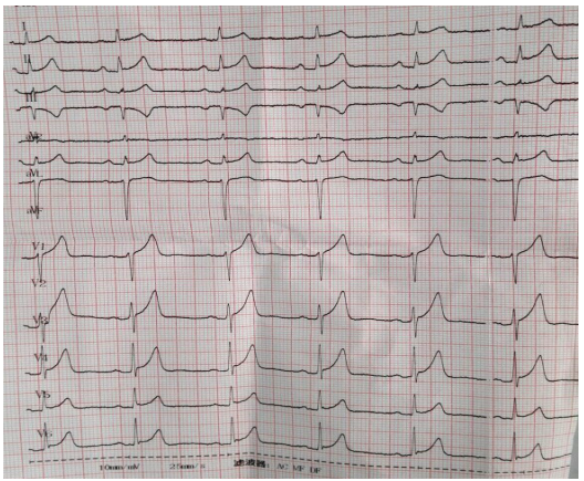【识图断案】st段抬高心电图汇总