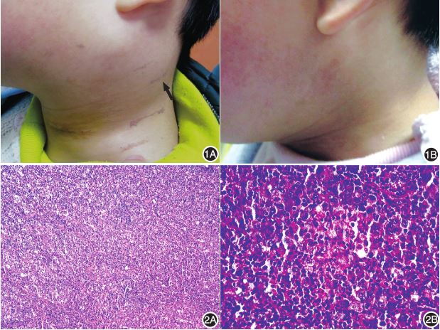 以颈部肿块为首发表现的儿童原发系统性间变性大细胞淋巴瘤一例