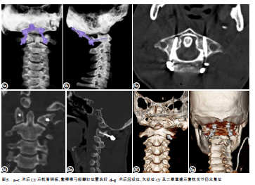 1例创伤性寰枕关节脱位的诊断与治疗