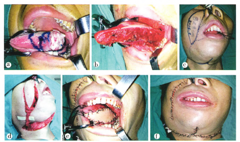 对侧面动脉蒂鼻唇沟岛状瓣修复舌癌术后缺损6例临床研究