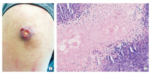 毛母质瘤继发感染1 例