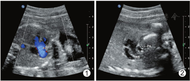 胎儿右室双出口肺动脉闭锁合并血管环超声表现1例