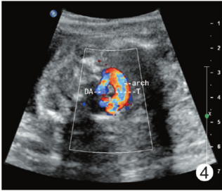 胎儿右室双出口肺动脉闭锁合并血管环超声表现1例