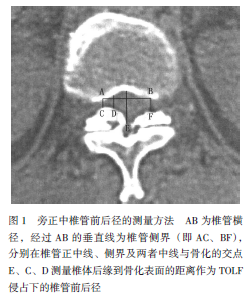 北京大学第三医院在tolf的病例对照研究中根据ct影像测量椎管矢状径