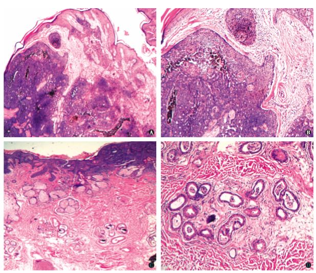 皮脂腺痣并发基底细胞癌及管状乳头状大汗腺腺瘤