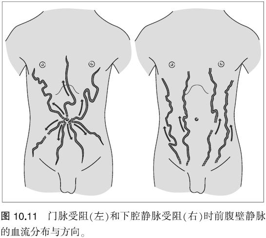 图文并茂 一起了解门脉高压的临床表现_门脉高压_临床表现_食管静脉