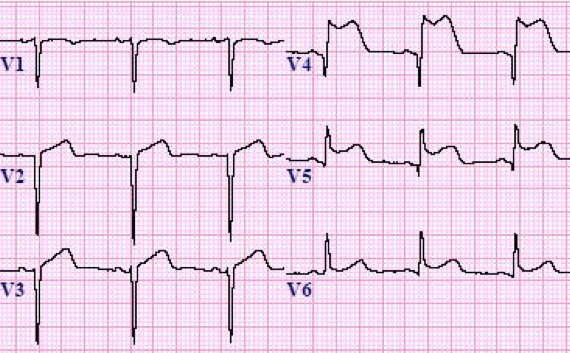 急性心梗的5类心电图表现,每个都值得你铭记在心!