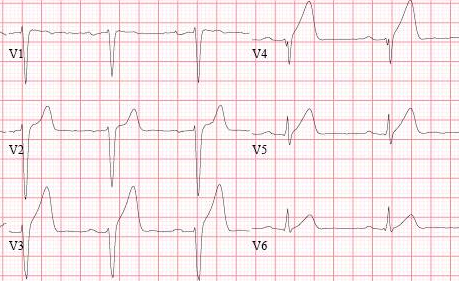急性心梗的5类心电图表现,每个都值得你铭记在心!