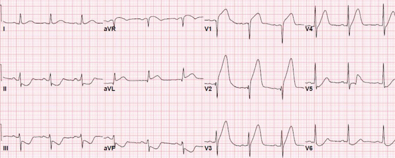 急性心梗的5类心电图表现,每个都值得你铭记在心!