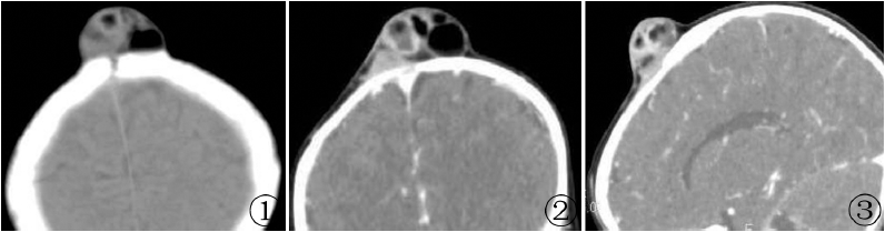 幼儿前囟区皮样囊肿1例