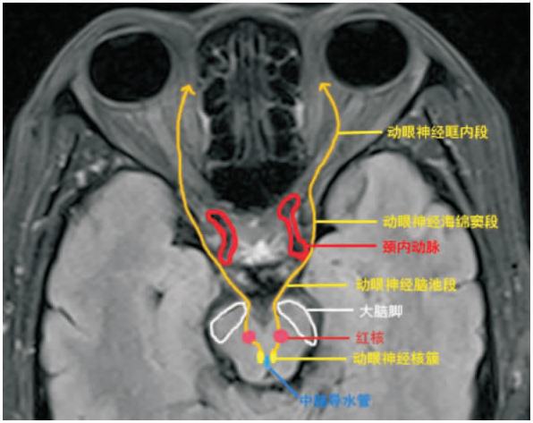 动眼神经解剖示意图