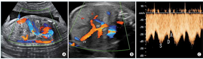 胎儿正常静脉系统超声检查