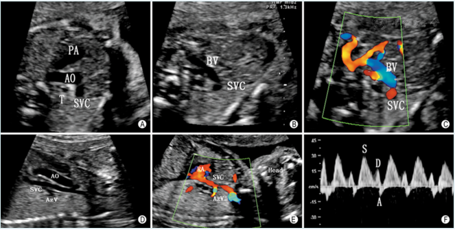 胎儿正常静脉系统超声检查