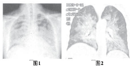 胸部典型征象丨蝶翼征