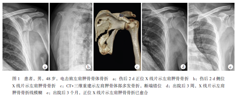 电击致肩胛骨骨折个案报告