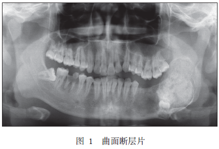 下颌骨骨化纤维瘤并发组合性牙瘤1例