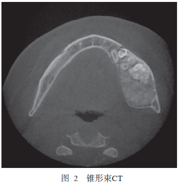 下颌骨骨化纤维瘤并发组合性牙瘤1例